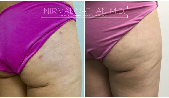 Nonsurgical before after 7