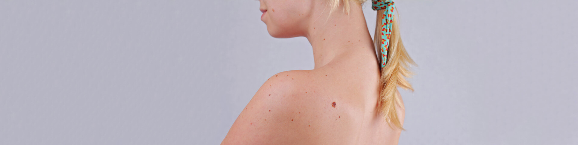 Woman with moles on her back