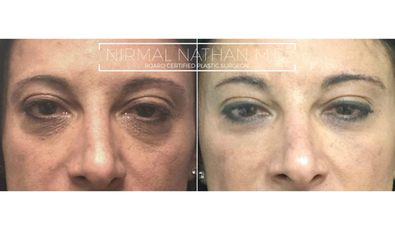 Nonsurgical before after 6