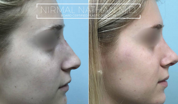 Face before after 4