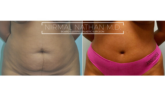 Body before after 3