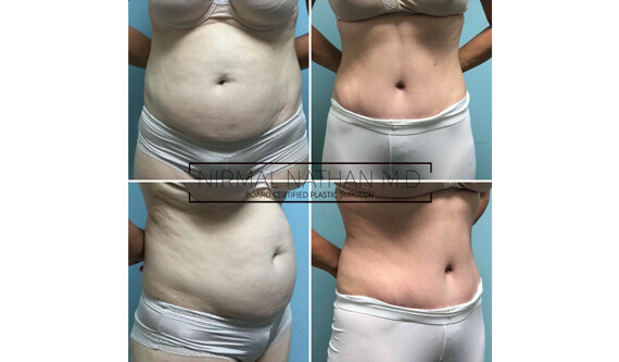 Body before after 4