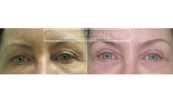 Face before after 5