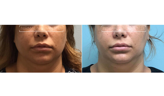 Nonsurgical before after 8