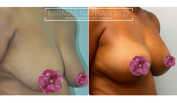 Breast before after 7