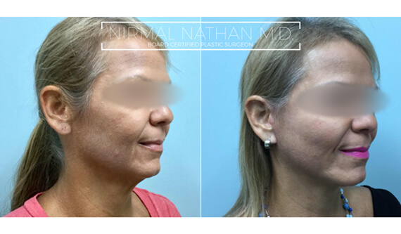 Face before after 7