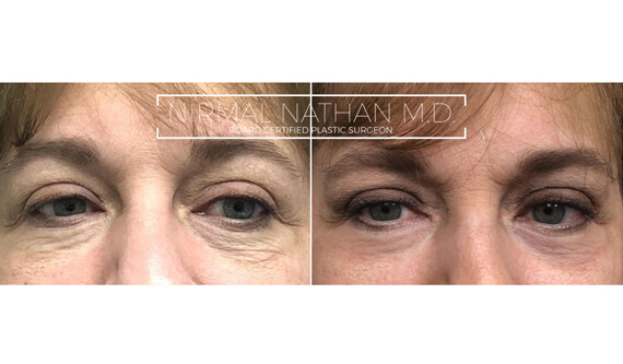 Nonsurgical before after 9