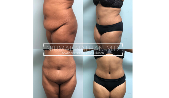 Body before after 5