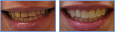 <?php echo $pk;?> - Before and After - Case 02