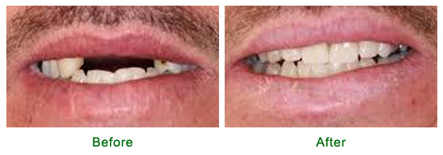<?php echo $pk; ?> - Before and After - Case 1