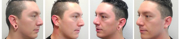 Earlobe Repair Before After 01