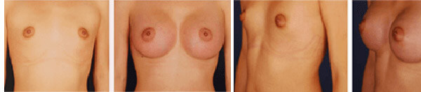TUBA Before After 03