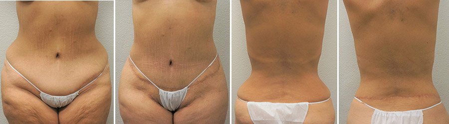 Circumferential Body Lift