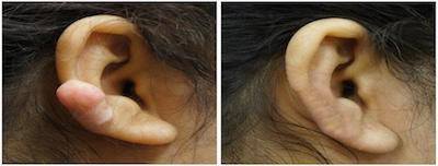 Excision of earlobe keloid with Kenalog injection treatment