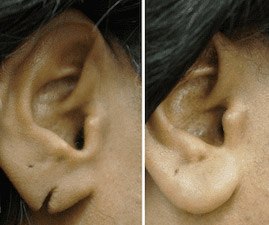 Primary Repair of Lacerated Earlobe 01