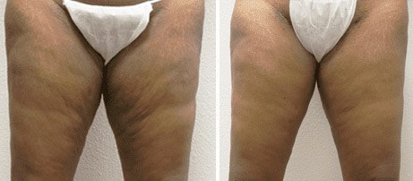 Inner Thigh Lift 01