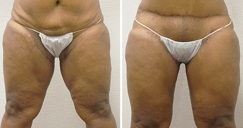 Inner Thigh Lift 02