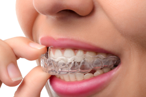 <?php echo $pk; ?> - Invisalign