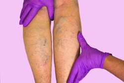 Dermatologist in Rockville, MD 20852 provides sclerotherapy for patients with spider veins