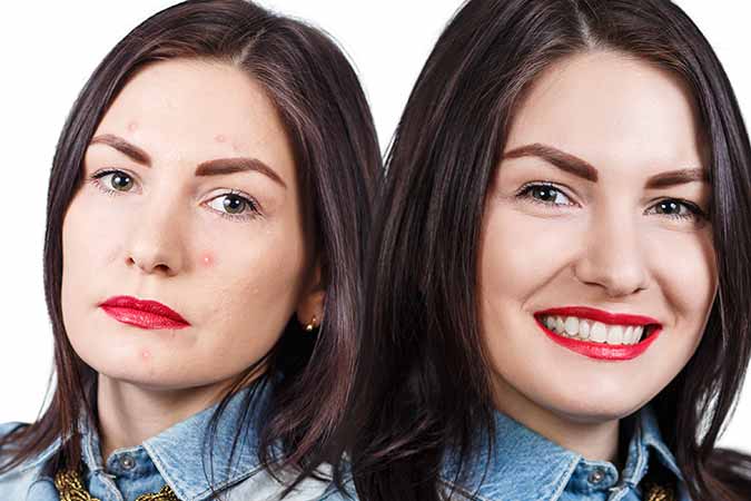 Effective treatment for acne scars in Bethesda, MD