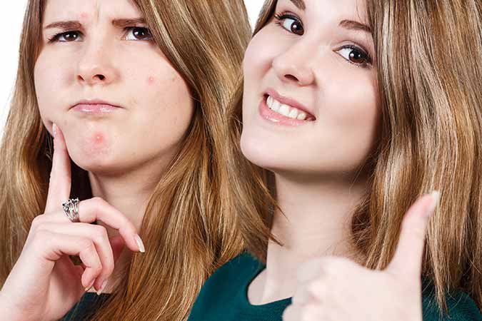 Best way to fight acne is with your dermatologist near Silver Spring
