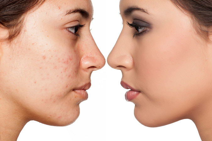 With customized chemical peels from your Damascus, Maryland area dermatologist, your skin will glow