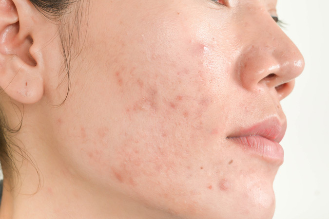 Frederick area dermatologist reviews dermal needling