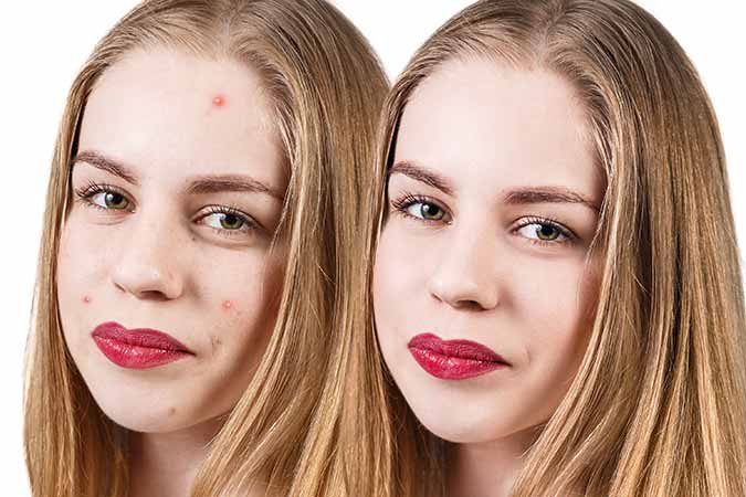Your dermatologist develops a plan for acne treatment in Frederick that will minimize the risk of scarring
