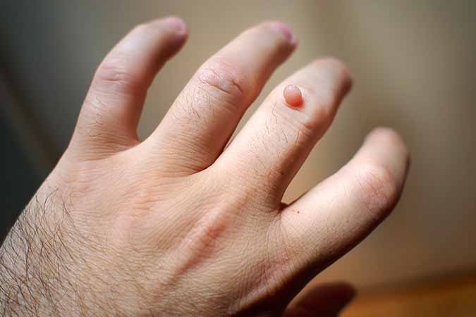Your dermatologist near Bethesda MD has a solution to warts