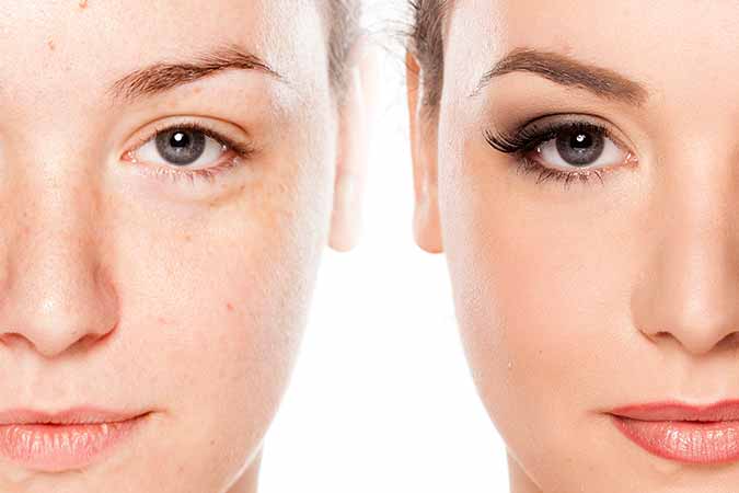 Patients in the Kensington area ask, does acne treatment through a dermatologist work?