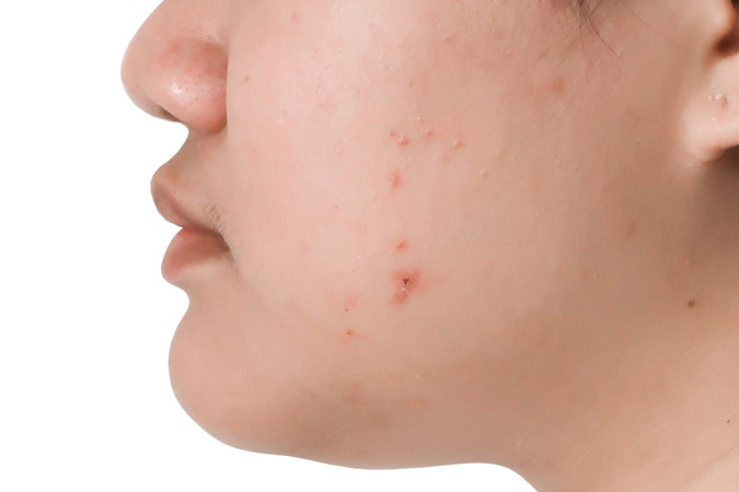 Rockville, MD dermatologist offers microneedling therapy
