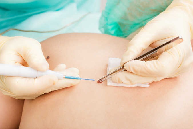 Potomac, MD reviews mole removal cost and expectations