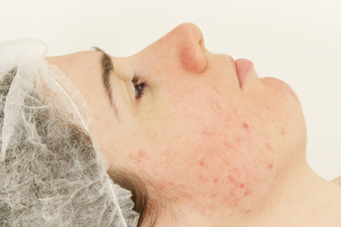 Why patient in Potomac should use the Microneedling device for acne scars