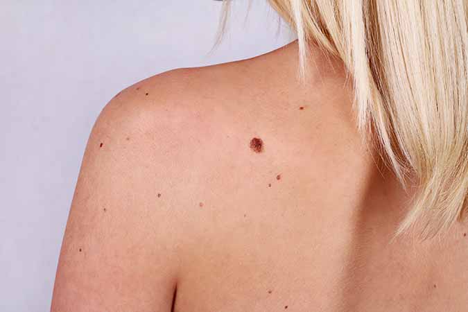 Are moles small skin problems that my Rockville dermatologist should remove?