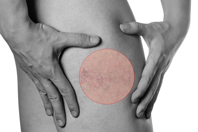 Effective treatment for spider veins on the legs in the Frederick area