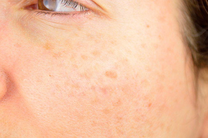 Patients near Frederick area ask about treatment for sun spots