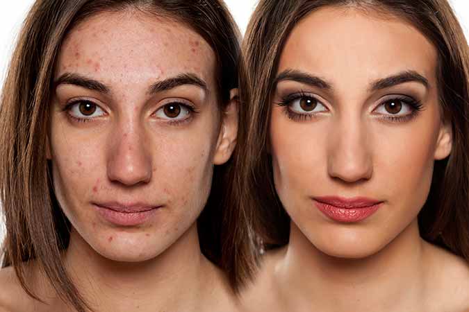 What is the cause of acne, and can dermatology treatment in Rockville clear my skin?