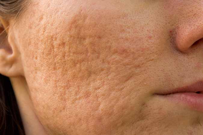 Potomac, MD area dermatologist describes what to use for acne scars
