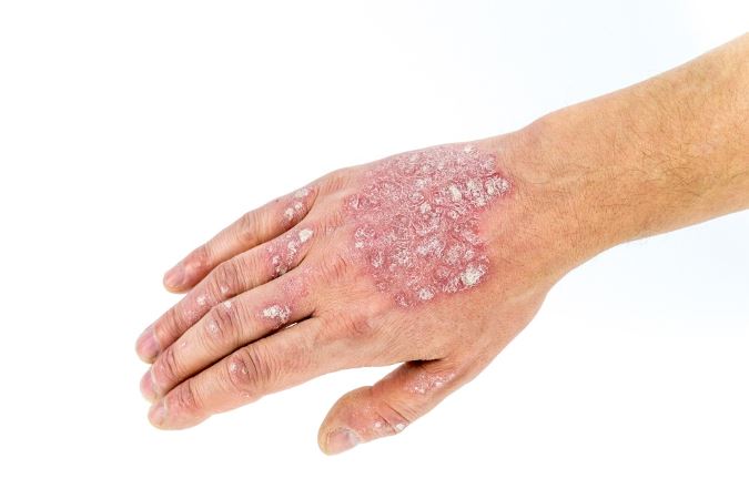 Potomac, MD area dermatologist addresses how to cure psoriasis