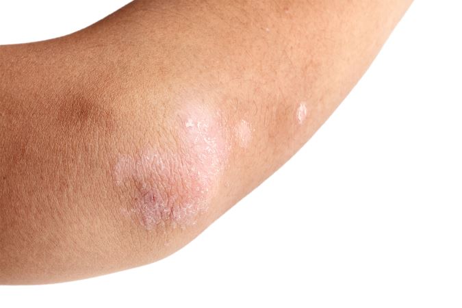 Rockville, MD patients with psoriasis seek relief for their itchy skin