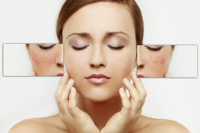 Rockville, MD gives an alternative to medication for rosacea