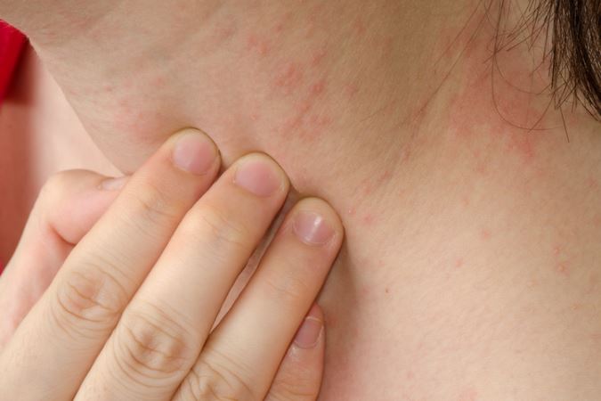Psoriasis a challenge met by your dermatologist in Maryland