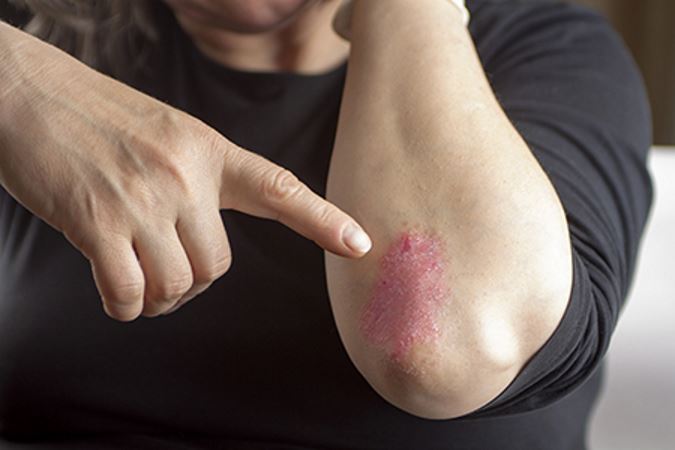 Psoriasis expert in the Rockville, MD area offers a variety of treatment options