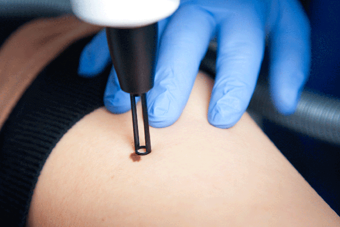 Urbana, MD area dermatologist offers laser treatments for the skin