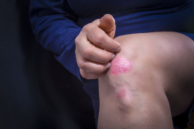 Possible causes and treatments for skin patches in Frederick MD