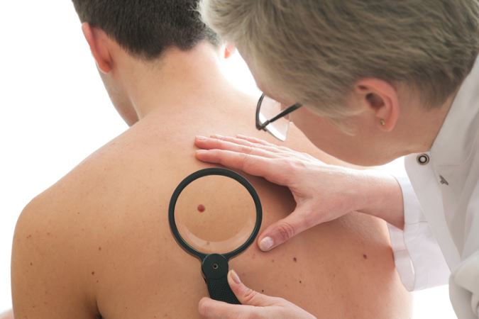 Potomac, MD doctor describes squamous cell carcinoma