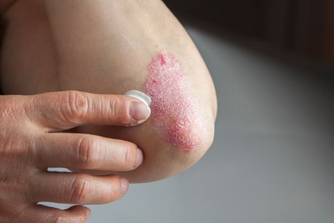 Keys to treating psoriasis with the help of your dermatologist in the Frederick area