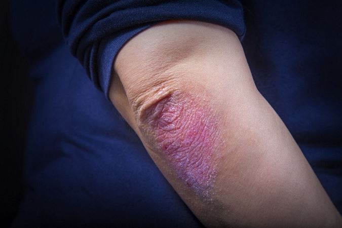 Rockville, MD physician offers ultraviolet treatment for psoriasis