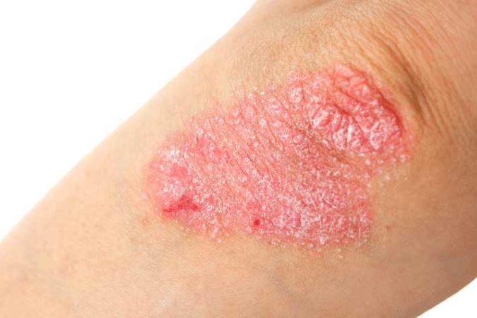 Rockville, MD area patients ask, what causes psoriasis of the skin?
