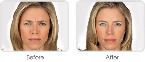 Botox BA 03